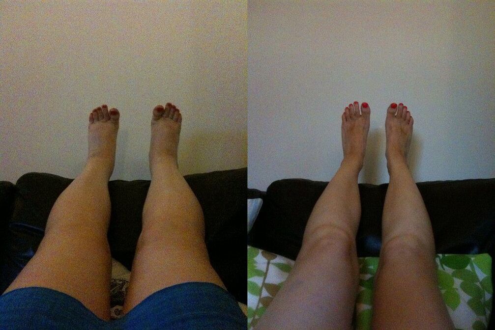 Effective result before and after the application of Margarita's Ostelife Premium Plus cream