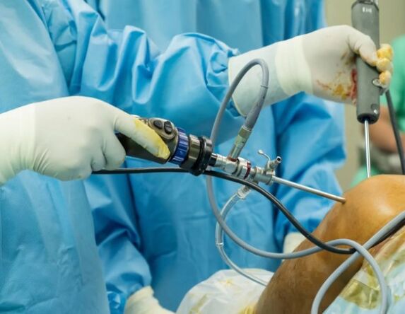Arthroscopy