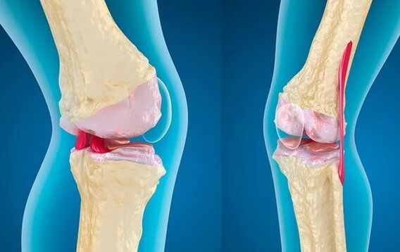 Gonartrosis of the 3rd degree of knee joint