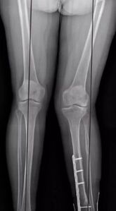 Knee deformations