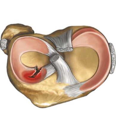 Menisc lesions