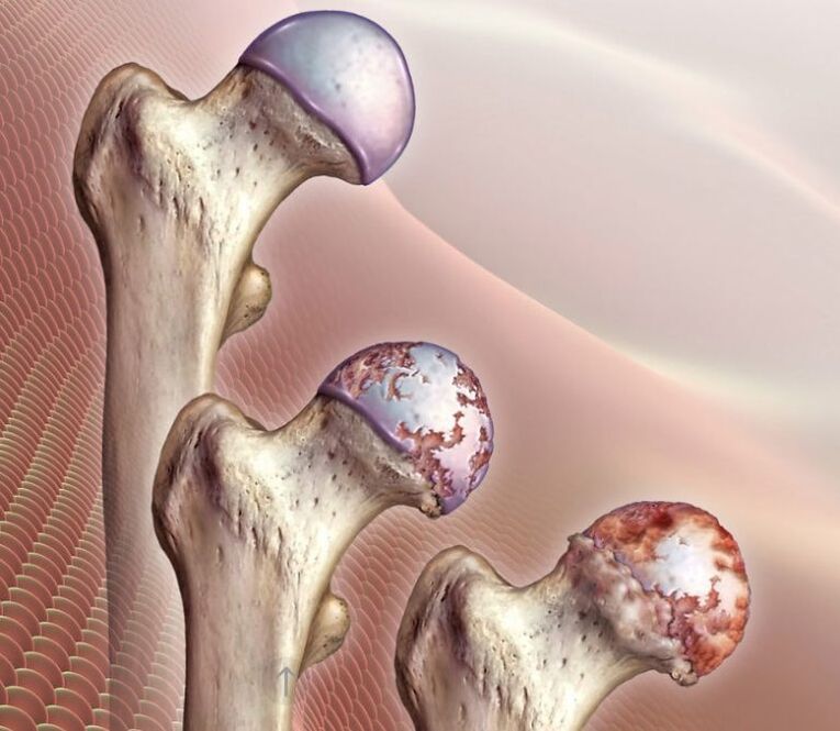 Arthrosis of the hip joint