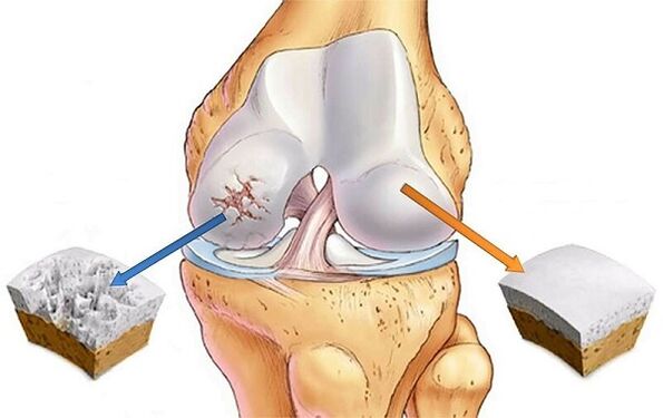 Norm and deviation for the arthrosis of the knee joint