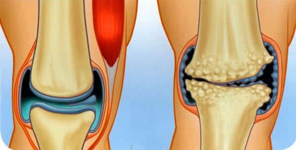 The normal condition of the joint and the causes of the development of knee arthrosis