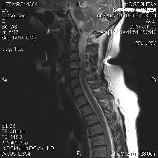 Osteochondrosis and spondylosis of the cervical column