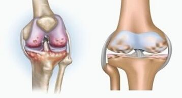 Causes of arthritis and arthrosis