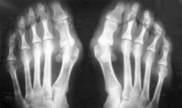 Differential diagnosis of the symptoms of arthritis and arthrosis