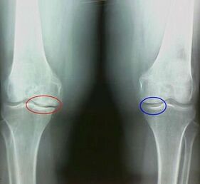The result of the treatment of popular arthritis and arthrosis remedies