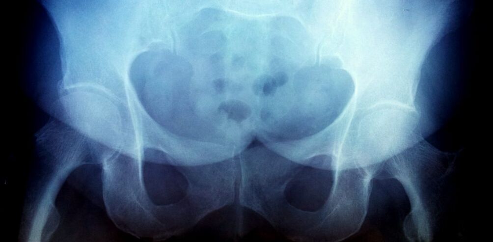X -ray image with osteoarthritis of the 2nd degree